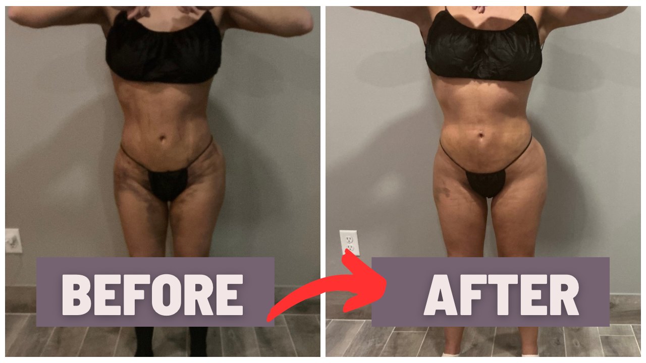Before and after results following liposuction and BBL with post-operative lymphatic drainage at Light Bodies