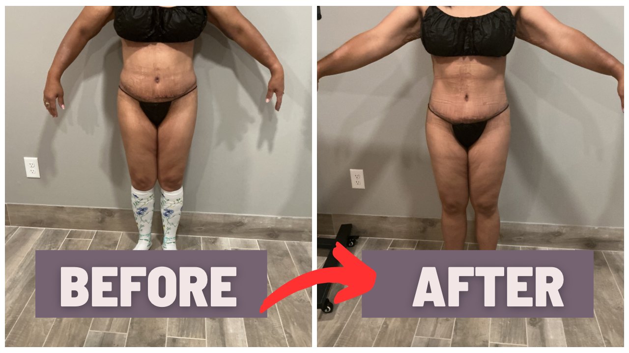 Before and after results following a mommy makeover with post-operative care at Light Bodies